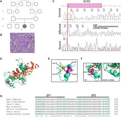 Frontiers Case Report A Novel In Frame Deletion Of GLIS2 Leading To